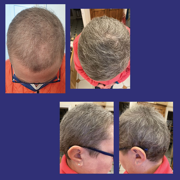 Anne Sophie témoigne de son expérience de soin de l'alopécie par photobiomodulation