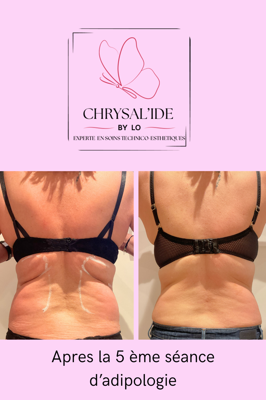 avant après : traitement minceur dos avec Adipologie® (résultats après 5 séances de soin)