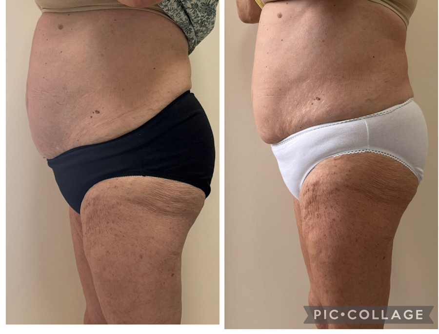 avant/après soin minceur Adipologie®3 séances