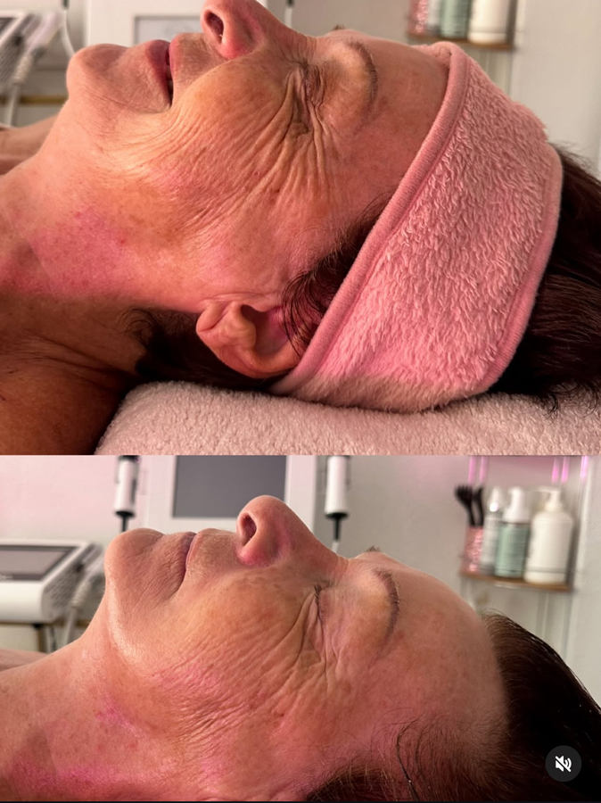 Avant-Après soin flash EsthéSkin®