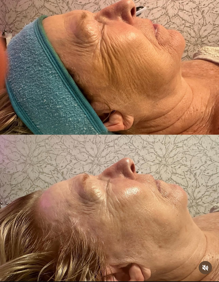 Avant-Après soin flash EsthéSkin® (x séances)