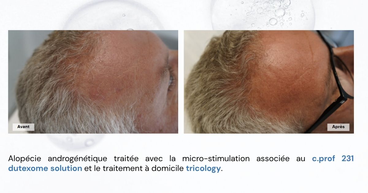 avant après traitement chute des cheveux microstimulatinon + tricology