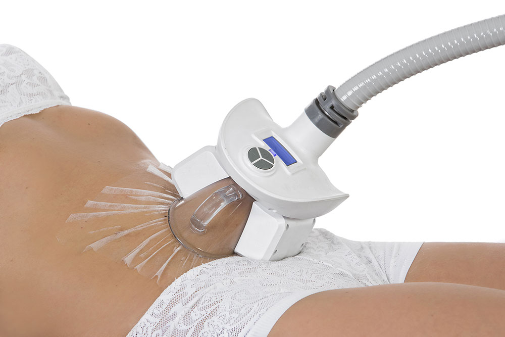 Aspiration du bourrelet abdominal pour cryolipolyse