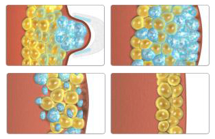 Cristallisation et élimination des cellules graisseuses