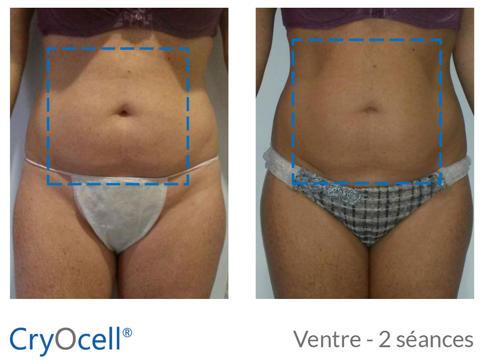 avant après 2 séances cryolipolyse ventre