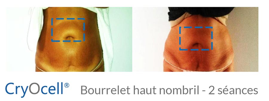 avant après traitement du bourrelet au dessus du nombril par cryolipolyse