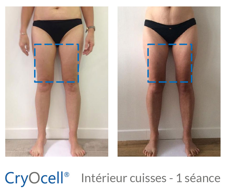 cryolipolyse face interne cuisse avant après
