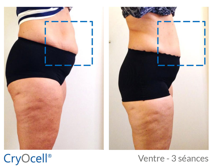 Traitement bourrelet abdominal par cryolipolyse
