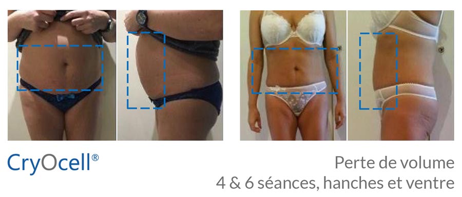 avant après traitement complet cryolipolyse