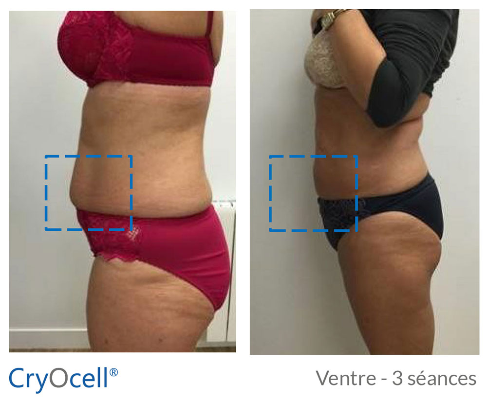 avant après Cryolipolyse ventre plat