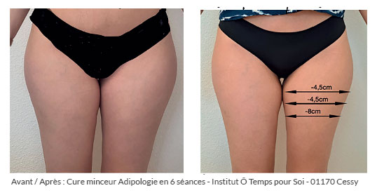avant après cure minceur adipologie pour affiner les cuisses