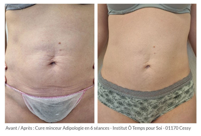 avant après cure minceur abdomen par Adipologie