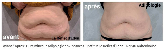 avant après cure minceur et anti-cellulite par ultrason ventre