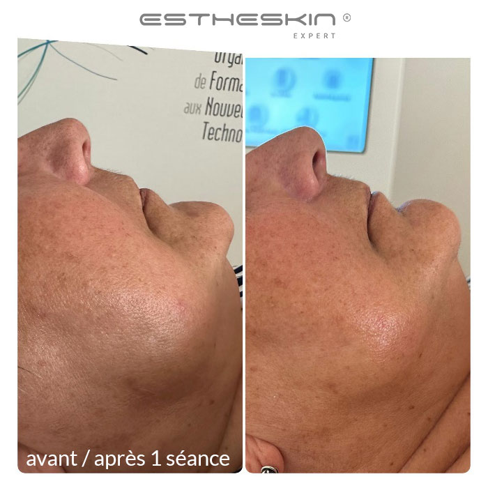 résultats avant après une séance hydradermabrasion avec EsthéSkin