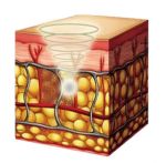 illustration ultrasons focalisés hifu