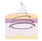 illustration diffusion ultraons multifocalisés