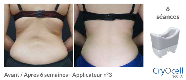 avant après cryolipolyse pli du soutien gorge en 6 semaines