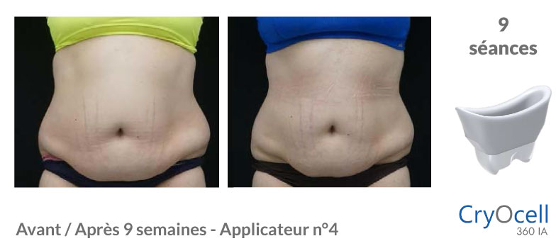 avant après cryolipolyse abdomen en 9 séances