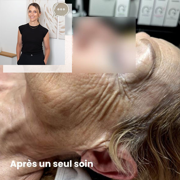 Résultats après un soin esthékin sur peau mature par Emilie Julia